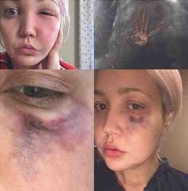 Meghan Linsey fue mordida por una araña ermitaña marrón en la cara